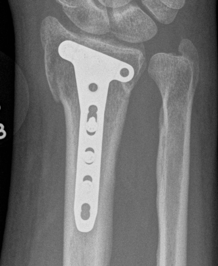 Distal Radius Plate AP